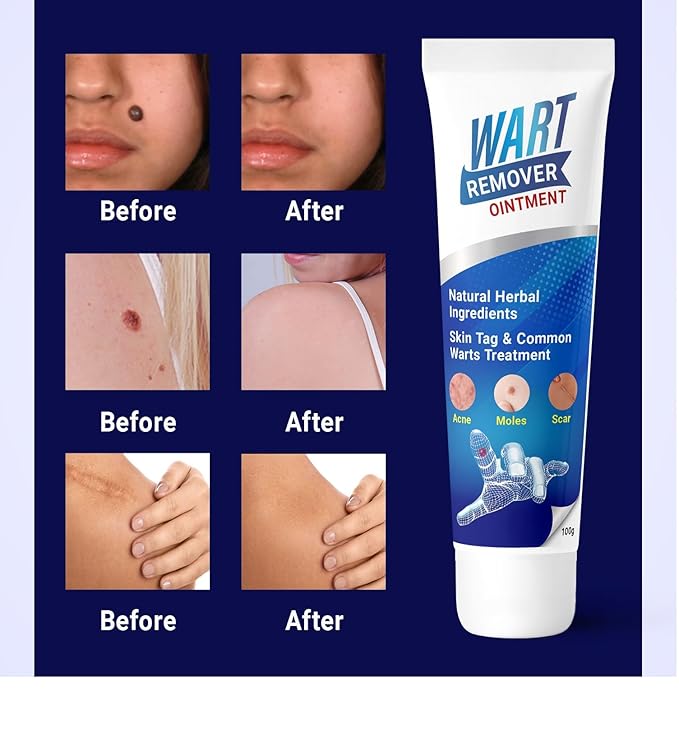 Wart Remover Instant Blemish Cream