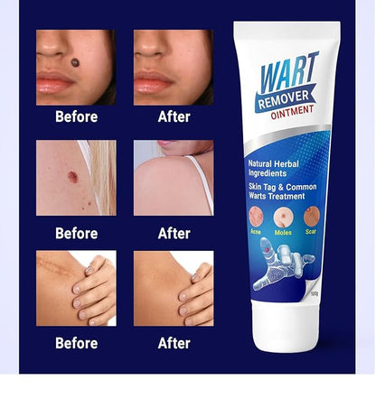 Wart Remover Instant Blemish Cream